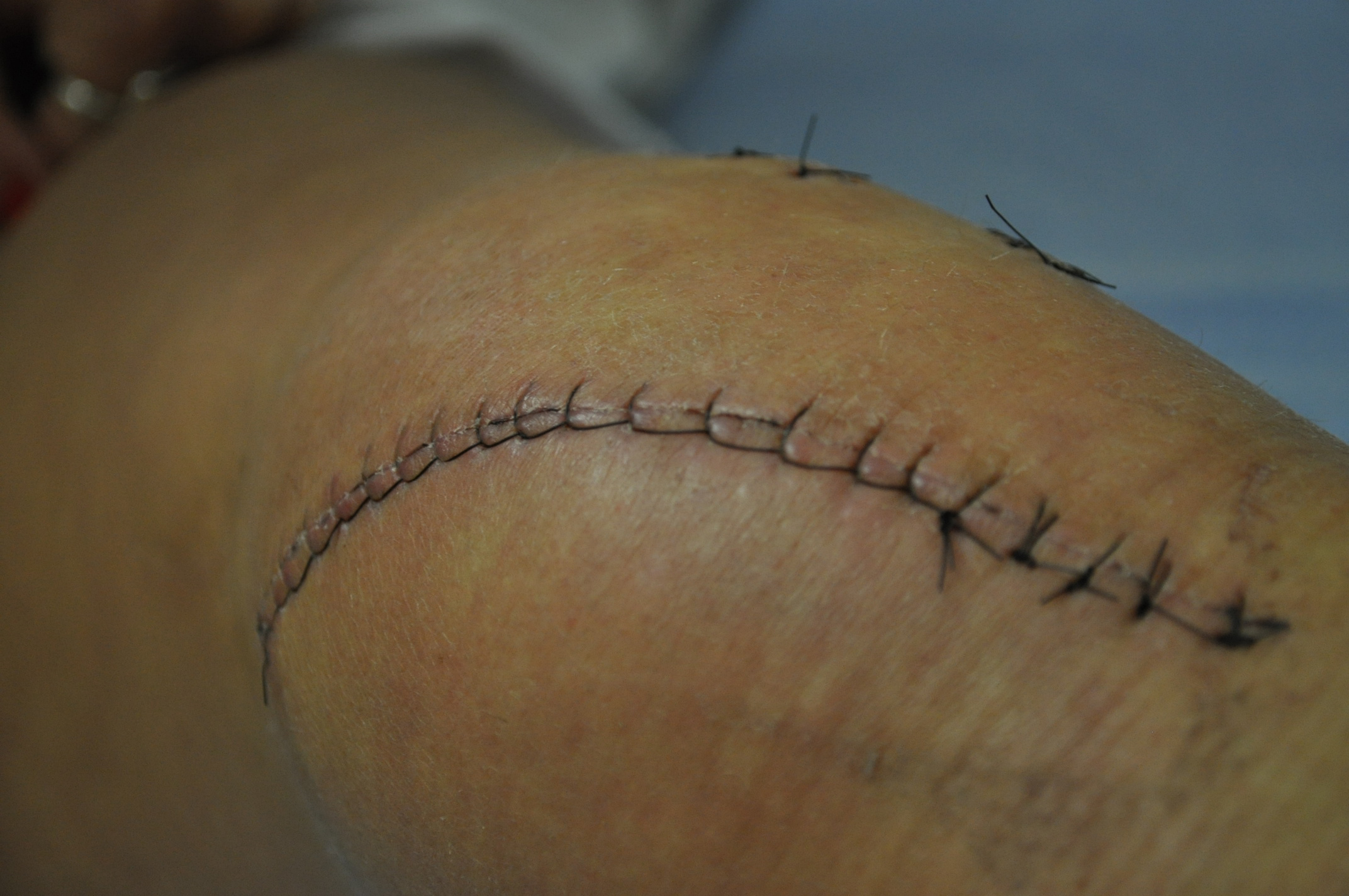 Stitches On Leg